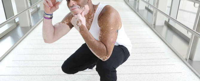 man with Vitiligo wearing a baseball cap crouching down