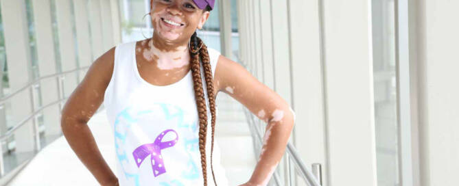 woman with Vitiligo smiling at the camera