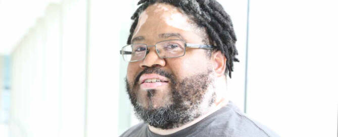 man with Vitiligo wearing glasses looking at the camera