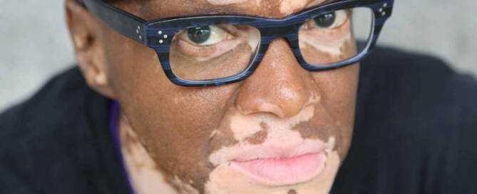 man with Vitiligo wearing glasses and a backwards cap closeup