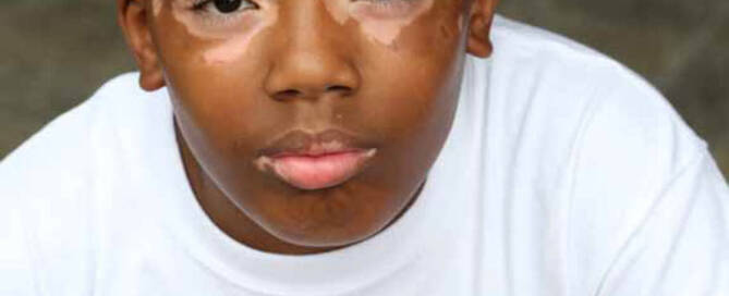 boy with Vitiligo looking into the camera closeup