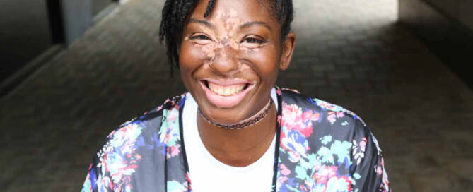 girl with Vitiligo smiling