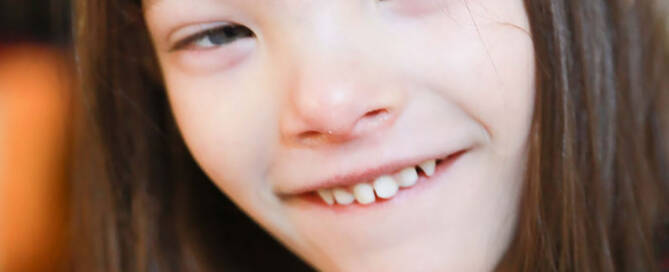 young girl with chromosome 5p- (Cri Du Chat) smiling into the camera, closeup photo