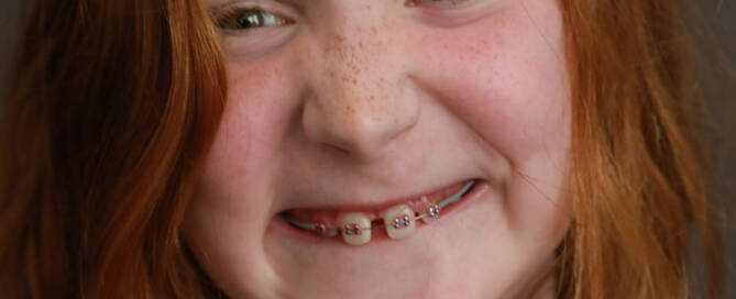 young girl with Phelan-McDermid Syndrome smiles at the camera, closeup photo