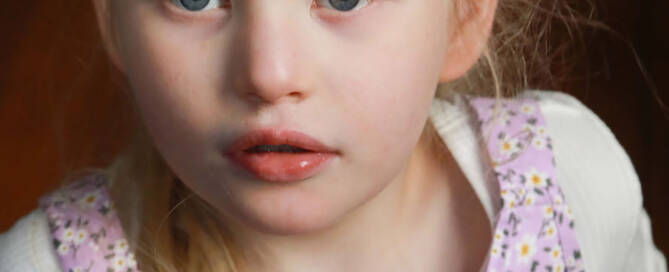 young girl with chromosome 5p- (Cri Du Chat) wearing pink dress looks into the camera, closeup photo