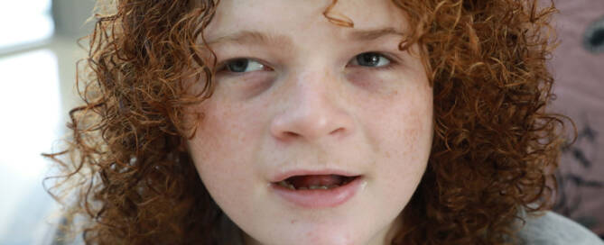 young girl with Angelman Syndrome looking to the left of the camera, closeup photo