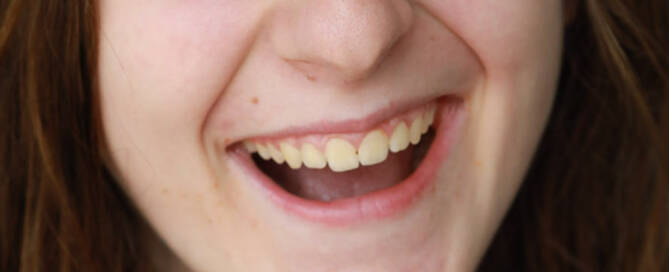 girl with Phelan-McDermid Syndrome looking to the left of the camera and laughing