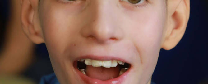 young boy with chromosome 5p- (Cri Du Chat) wearing blue shirt and smiling, closeup photo