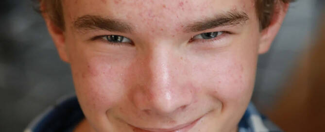 boy with xxy syndrome wearing flannel shirt smiling into the camera, closeup photo