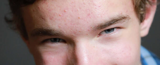 boy with xxy syndrome wearing flannel shirt smiling into the camera, closeup photo