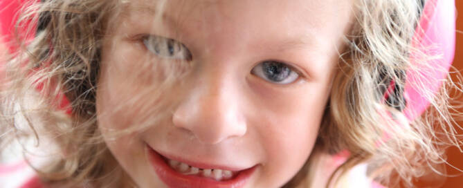 girl with williams syndrome smiling, close up photo