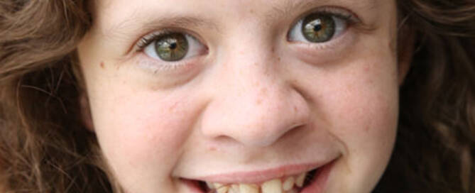 girl with williams syndrome smiling at the camera, close up photo