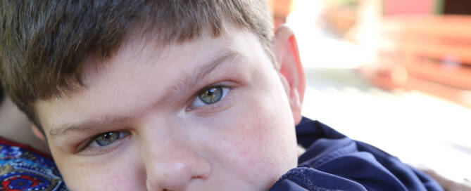 boy with williams syndrome rests his head on his arm, looking into the camera