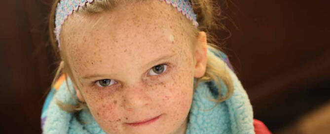 young girl with Xeroderma Pigmentosum