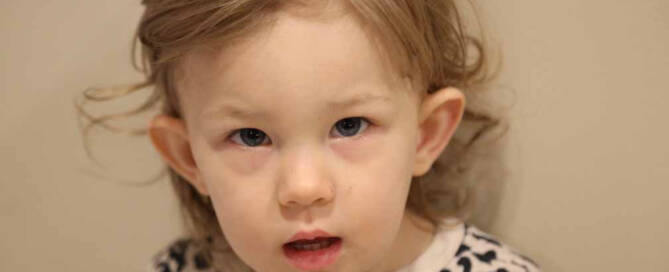 toddler girl with Xeroderma Pigmentosum looking at the camera